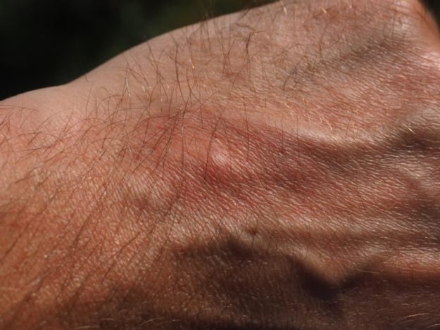 Cuándo ir al médico tras picaduras de insectos