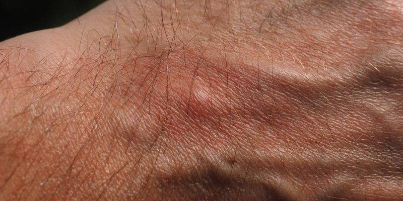 Cuándo ir al médico tras picaduras de insectos