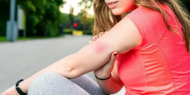 ¿Qué tipo de mosquito me ha picado – A tu Salud ¿Qué tipo de mosquito me ha picado - A tu Salud